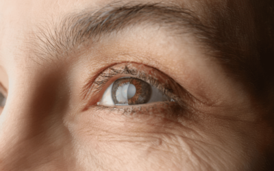 How Do I Know When I Need Cataract Surgery?