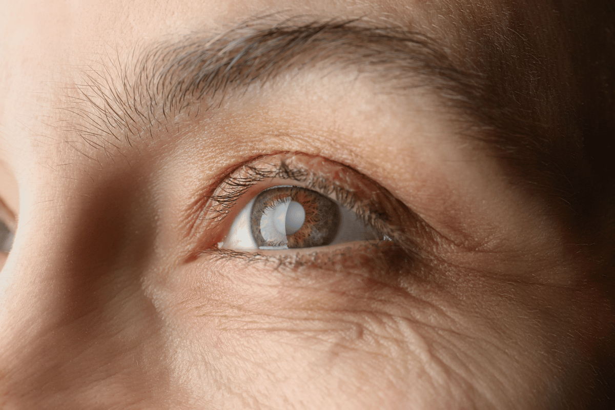 close-up of an eye with a cataract